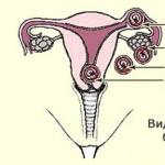 Симптомы внематочной беременности в первые дни